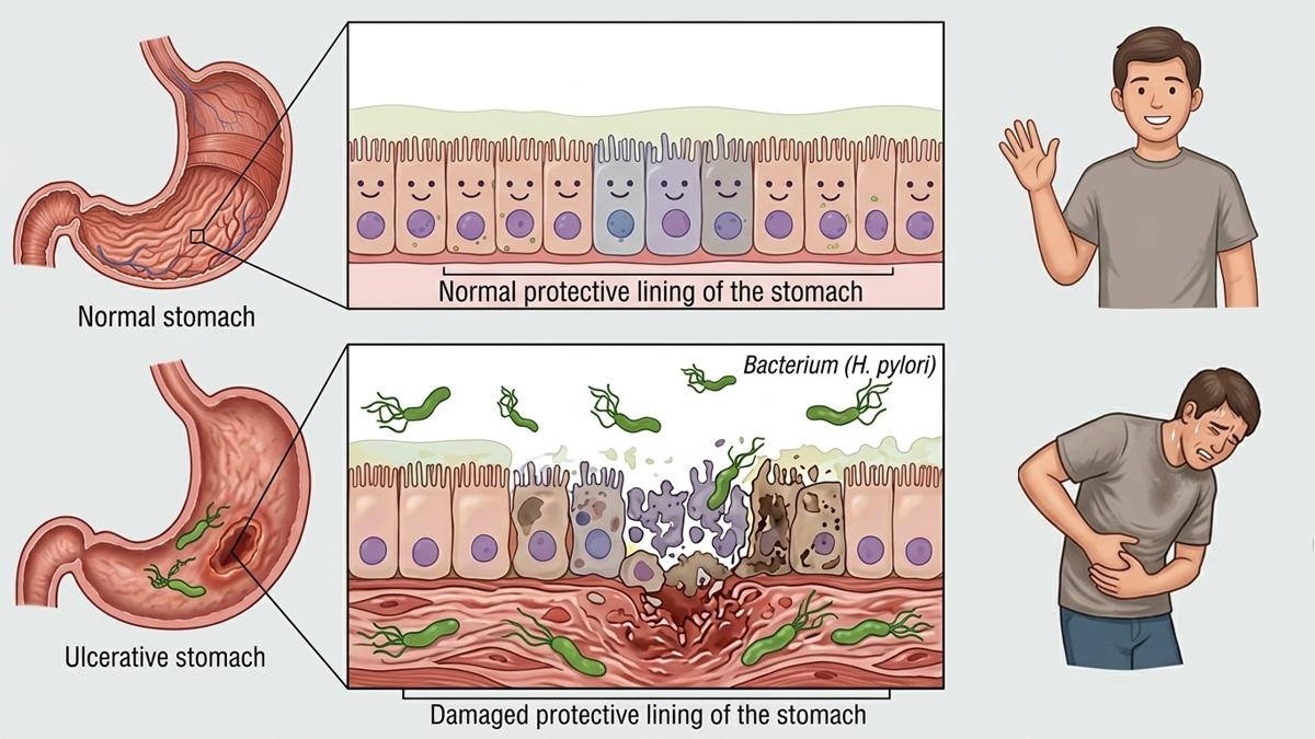 helicobacter pylori effects_illustration Ali Raza.jpg